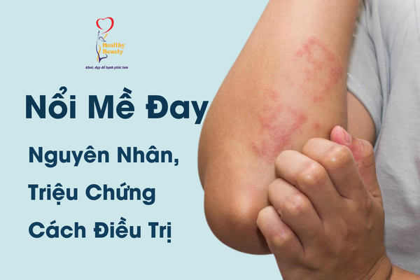 Nổi Mề Đay (Mày Đay): Nguyên Nhân, Triệu Chứng Và Cách Điều Trị ...